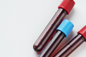 O TRT-17 manteve a condenação de empresa por dispensa discriminatória de uma trabalhadora com diagnóstico de HIV